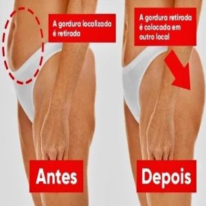 Lipoenxertia: o que é, para que serve e como é a recuperação
