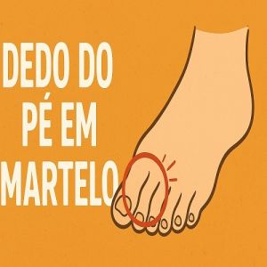 Dedo do pé em martelo? Quais as causas, sintomas e soluções!