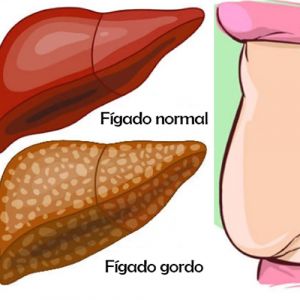 Dieta para gordura no fígado