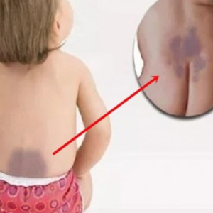 Você ficará em choque com o verdadeiro significado da mancha roxa nos recém nascidos