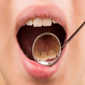  Remova o tártaro dos seus dentes de forma natural