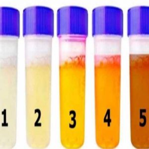 Sua urina fica dessa cor? Então você precisa saber disso com urgência