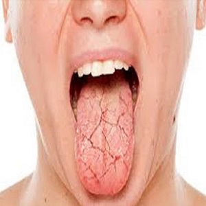Língua fissurada - veja porque acontece!