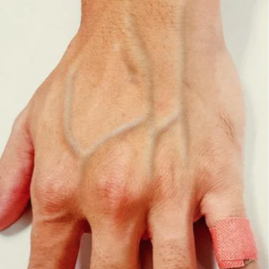 Suas veias são saltadas? Então você precisa saber o que isso significa