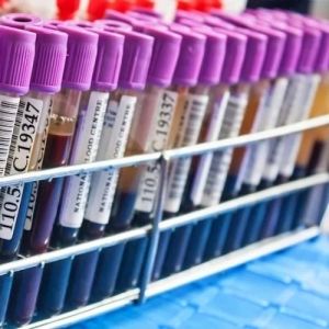 Exame PSA: o que é, para que serve e como entender o resultado