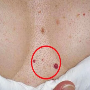 Você tem esses pontos vermelhos em algum lugar do corpo? Descubra o que são e como surgem!