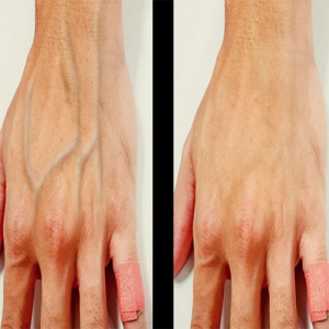 Suas veias são saltadas? Então você precisa saber o que isso significa