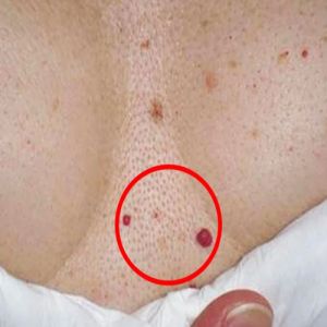 Você tem esses pontos vermelhos em algum lugar do seu corpo? Descubra o que são e como surgem!