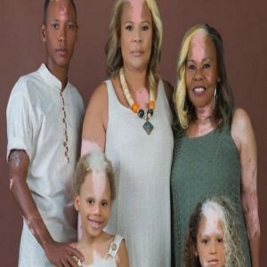 Samuel Purificação: criança brasileira com piebaldismo se destaca como modelo internacional