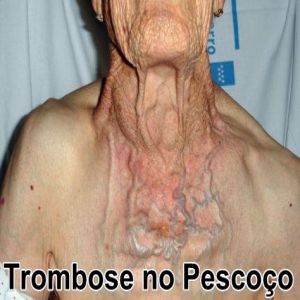 Trombose no pescoço: Sintomas, causas e tratamento da trombose