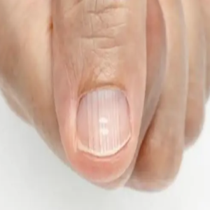 Você nem imagina o motivo de surgirem estas listas brancas em suas unhas