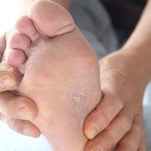 Rachaduras nos pés, o que causa e como fazer para tratar