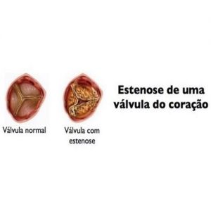 Estenose Aórtica: o que é, sintomas e tratamento
