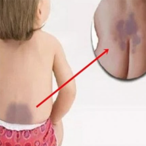 Você ficará em choque com o verdadeiro significado da mancha roxa nos recém nascidos