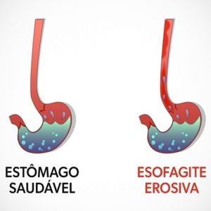 Esofagite erosiva: o que é, tratamento e classificação de Los Angeles