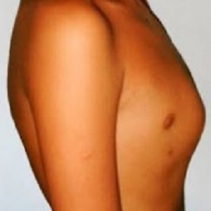  Peito de pombo - saiba o que é, e como corrigir