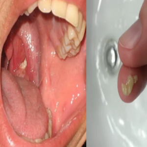 Você sabe o que são aquelas bolinhas fedidas que aparecem na garganta?