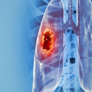 Seis tipos de câncer que podem ser prevenidos