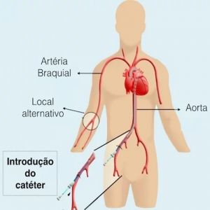 Cateterismo cardíaco: o que é, como é feito e possíveis riscos
