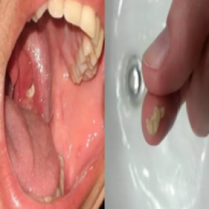 Você sabe o que são aquelas bolinhas fedidas que aparecem na garganta? Você ficará surpreso em saber