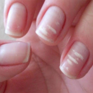 Você nem imagina o motivo de surgirem estas listas brancas em suas unhas