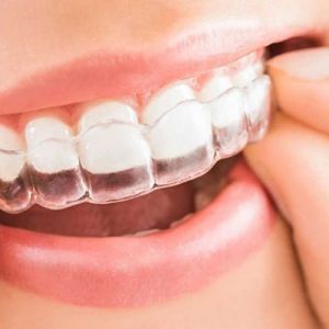 Saiba tudo sobre o Invisalign