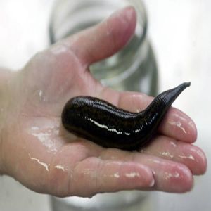 Sanguessuga de 10 cm Retirada da Traqueia de Garoto na China