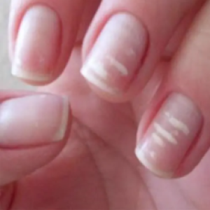 Você nem imagina o motivo de surgirem estas listas brancas em suas unhas