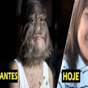 Lembra da garota mais peluda do mundo? Você não vai acreditar ao ver como ela ficou após se depilar para casar