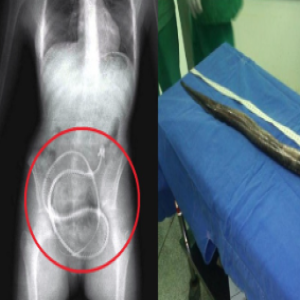 8 coisas vivas que já foram encontradas dentro de pessoas