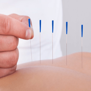 Conheça essas 4 curiosidades sobre a acupuntura