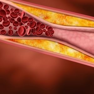 5 Principais Causas da Aterosclerose