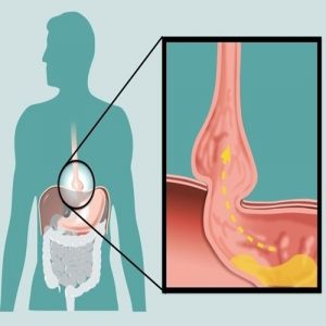 O que é refluxo gastroesofágico, os seus sintomas e como é feito o diagnóstico e o tratamento