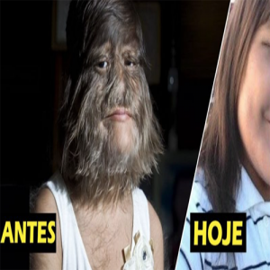 Lembra da garota mais peluda do mundo? Você não vai acreditar ao ver como ela ficou após se depilar para casar