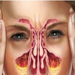  7 formas naturais de curar os sintomas de sinusite