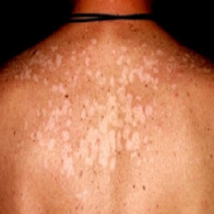  Hifas septadas - fungos causadores de micoses