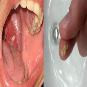 Você sabe o que são aquelas bolinhas fedidas que aparecem na garganta? Você ficará surpreso em saber