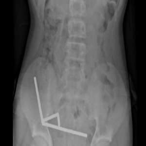 Adolescente perde parte do intestino após engolir mais de 80 imãs